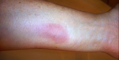 Pictures of Skin Rash - Get Info on all types of rashes