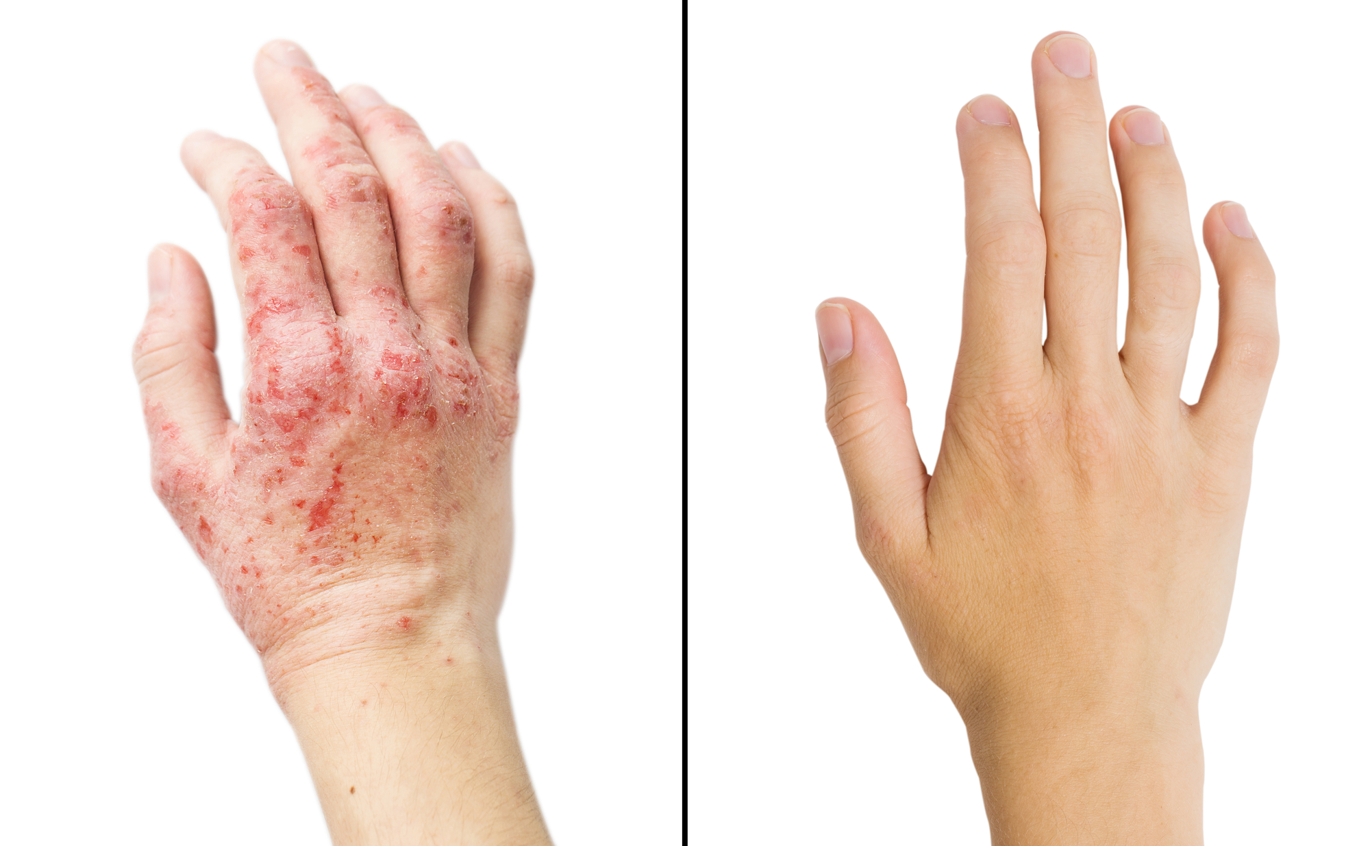 pictures-of-eczema-contact-dermatitis-pictures