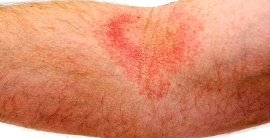 Pictures of Skin Rash - Get Info on all types of rashes