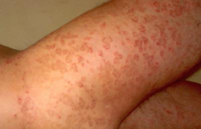 Type of Skin Rash