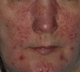 Rosacea Pictures – Natural Rosacea Awareness