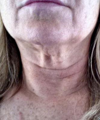 Sagging Neck Skin Caused by Neck Exercises?