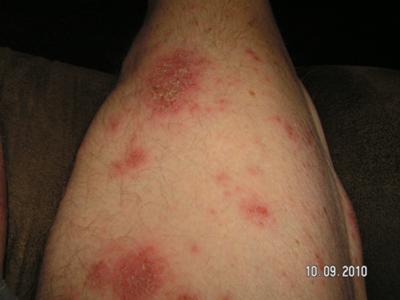 Types of skin Rash Pictures