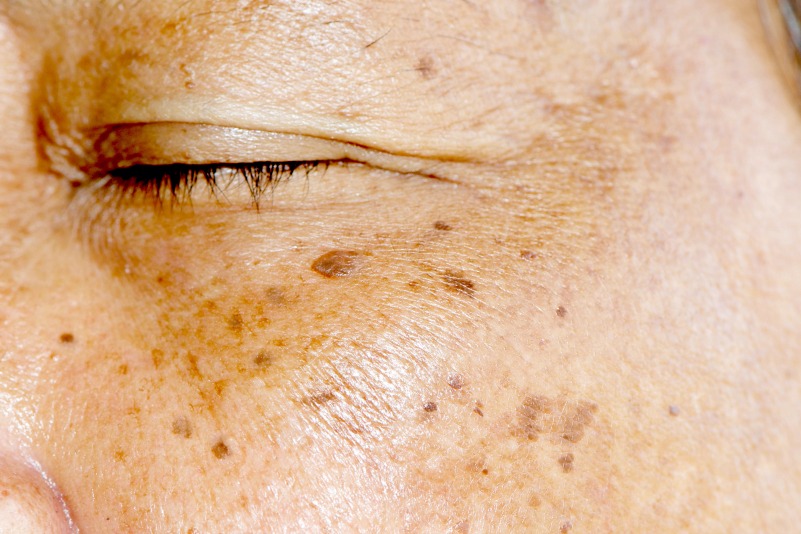 causes-of-hyperpigmentation-how-to-fade-age-spots