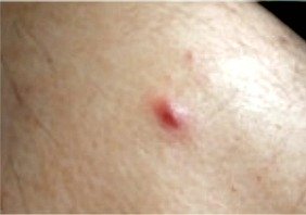 treatment skin boil on Abscess Boils, skin and Cures boils Types â€“ Causes, of