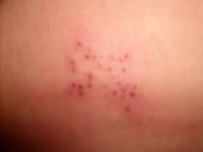 Pictures Of Skin Rash Get Info On All Types Of Rashes