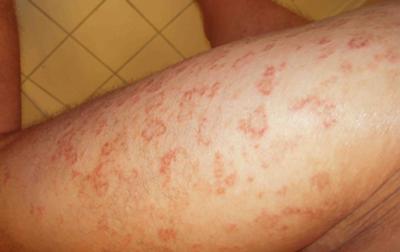 Type of Skin Rash