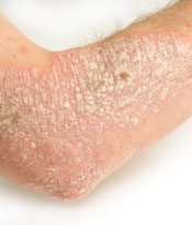 Cure For Psoriasis Itching - Psoriasis Cures Approved Ingredients